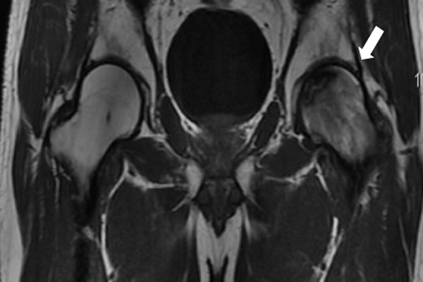 Necrosis ósea avascular