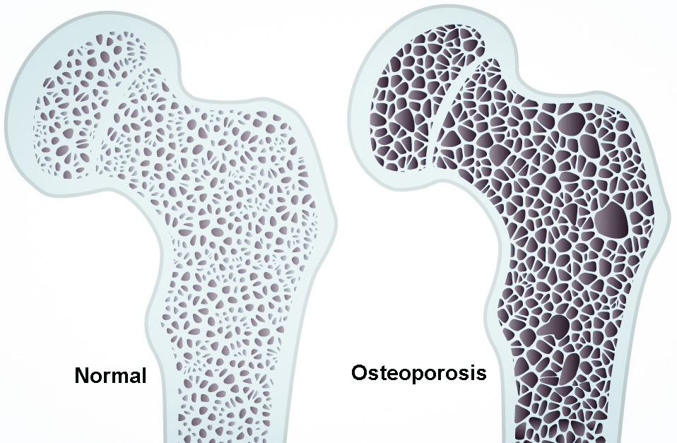 1-osteoporosis1