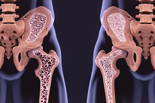 Osteopenia - Osteoporosis