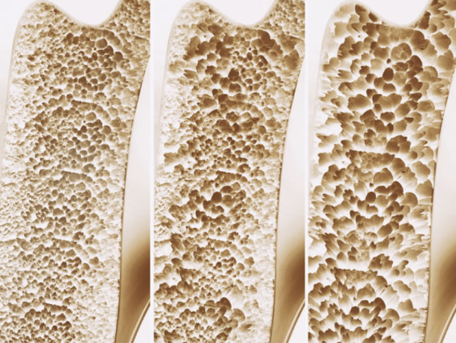 osteoporosis2